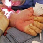 دست قطع شده دختر 9 ساله در تبریز پیوند شد